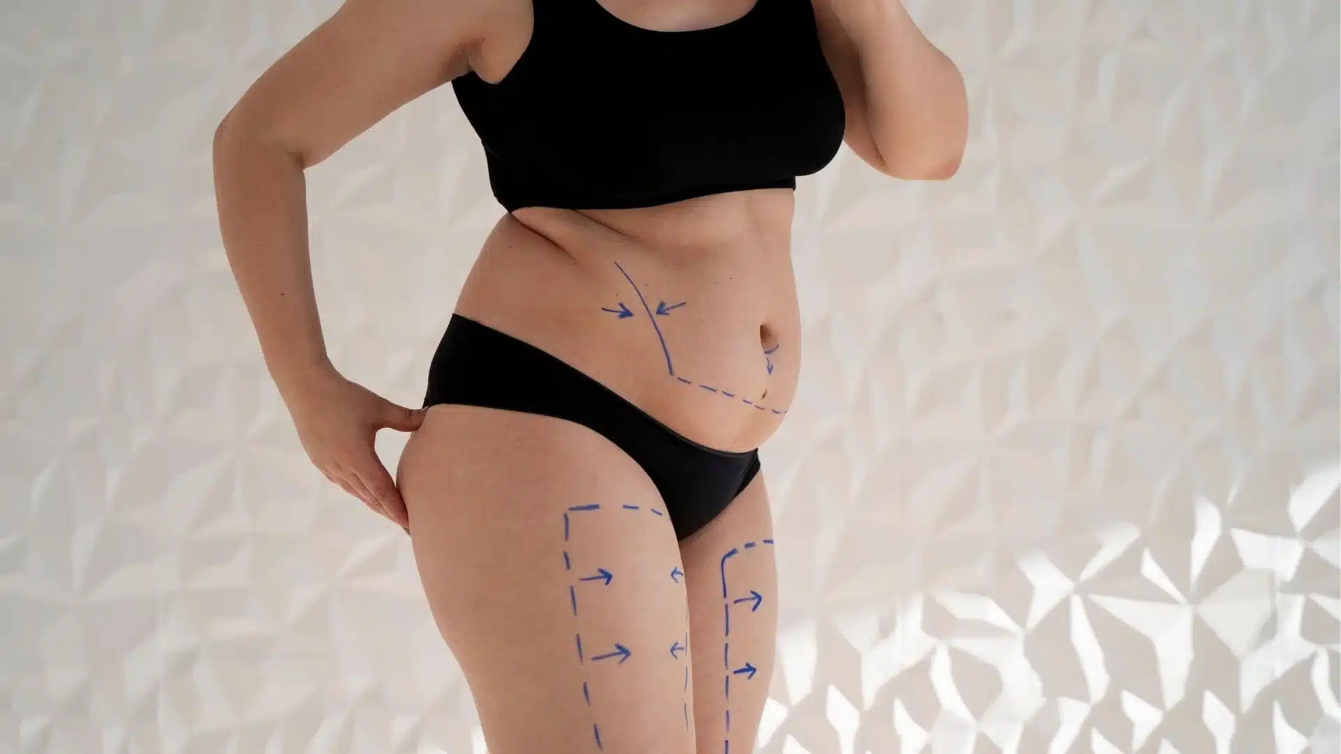 ¿Es Posible Recuperar Mi Cuerpo Anterior al Bebé con Mommy Makeover?