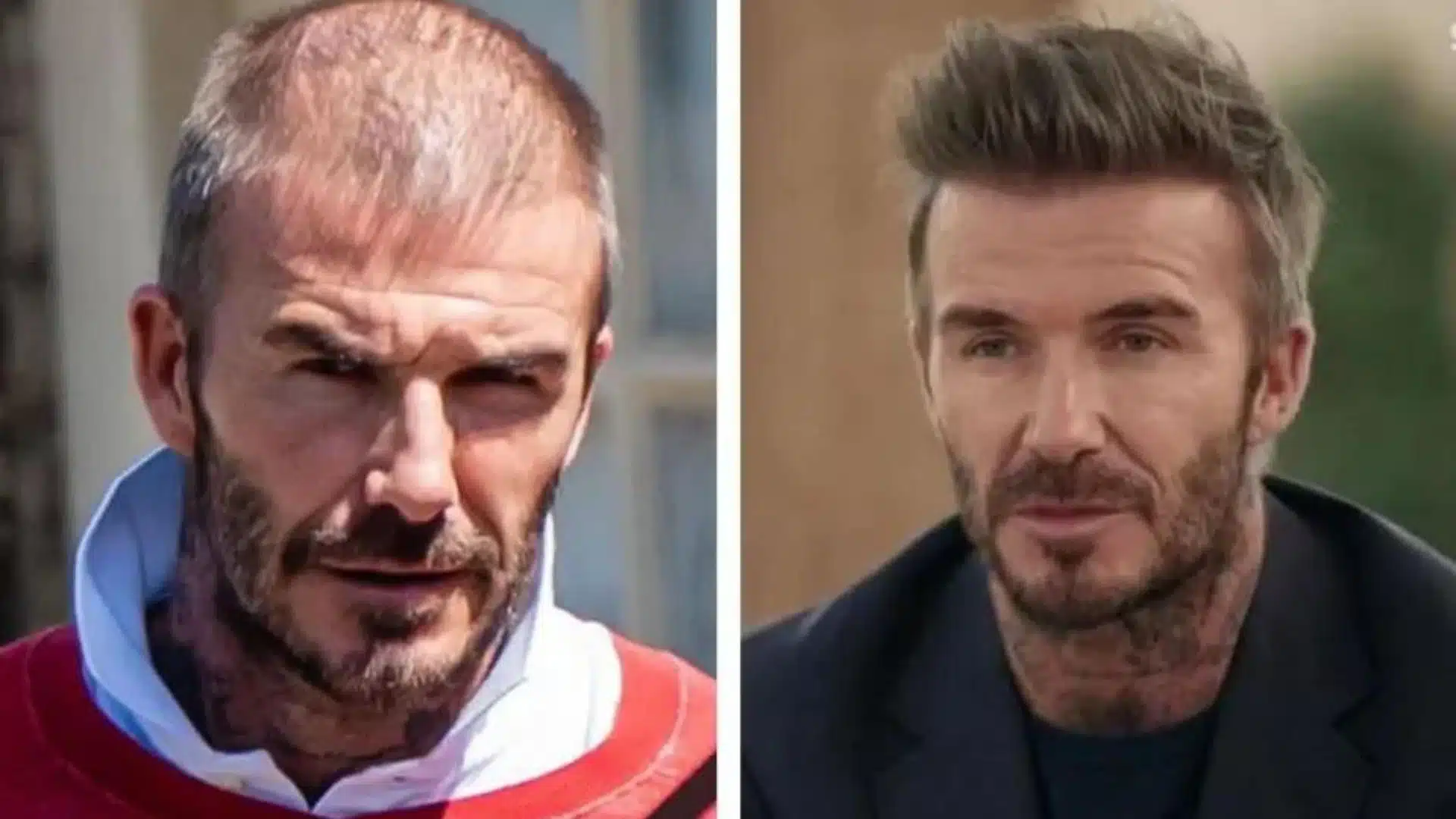 David Beckham’s Hair Secrets: Natural Look with a Hair Transplant