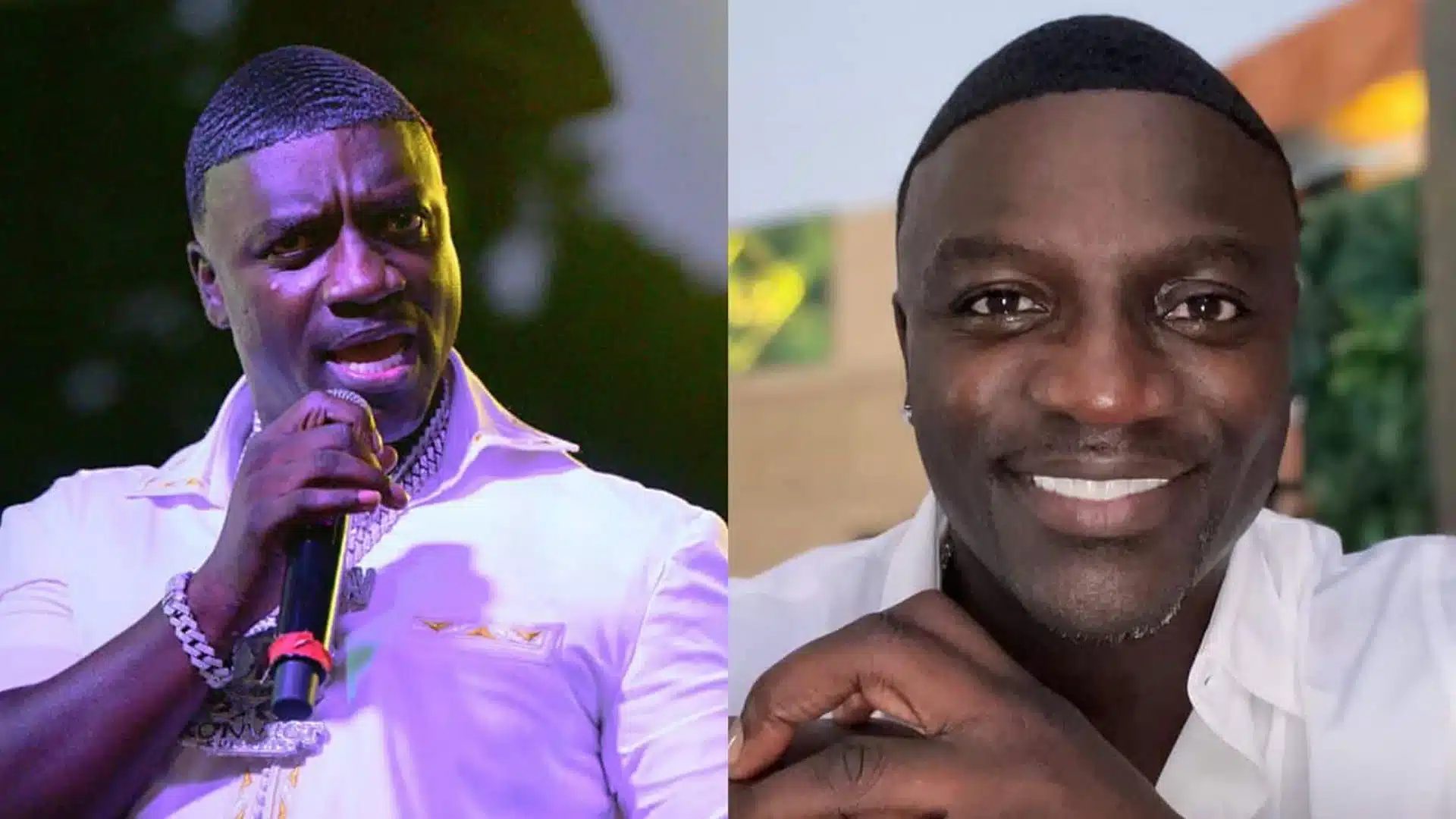 Famous Singer Akon Has Undergone Hair Transplant in Turkey