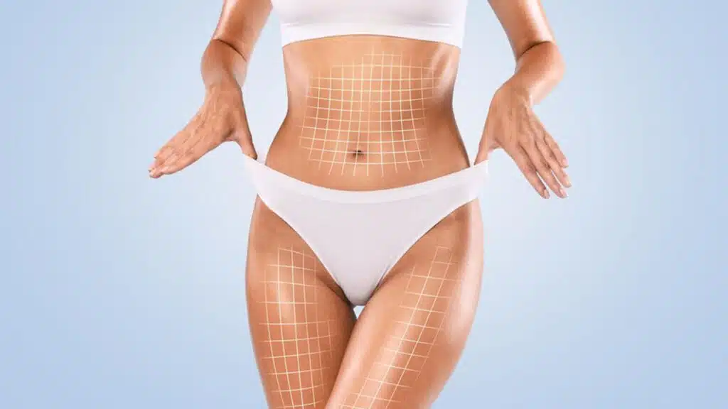 Geleneksel Lipo, Vaser Lipo ve Laser Lipo: Farkları Neler? 1 2 1