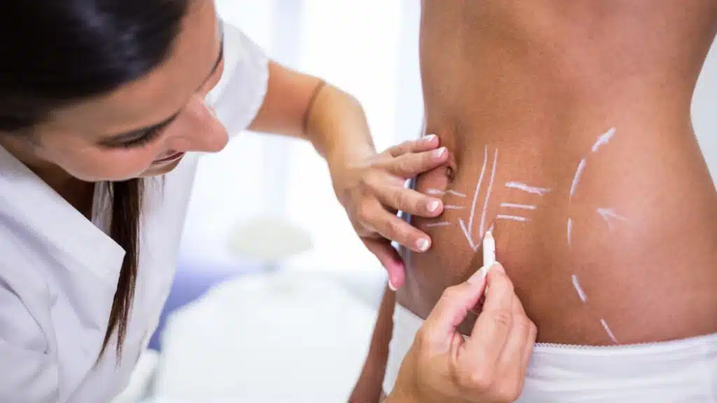 Geleneksel Lipo, Vaser Lipo ve Laser Lipo: Farkları Neler? 2 3 1