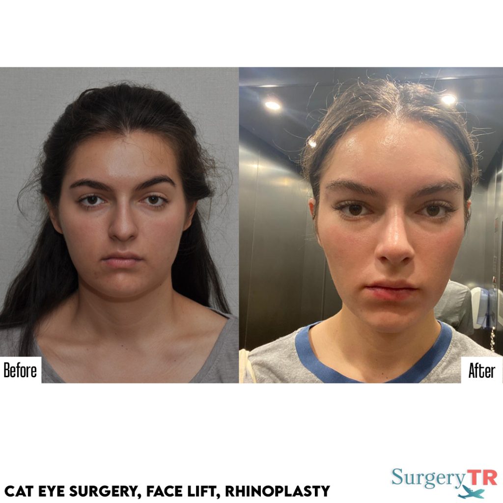 La estética de “apariencia natural” en Turquía: ¿Es posible lucir como Molly-Mae? 3 6 1
