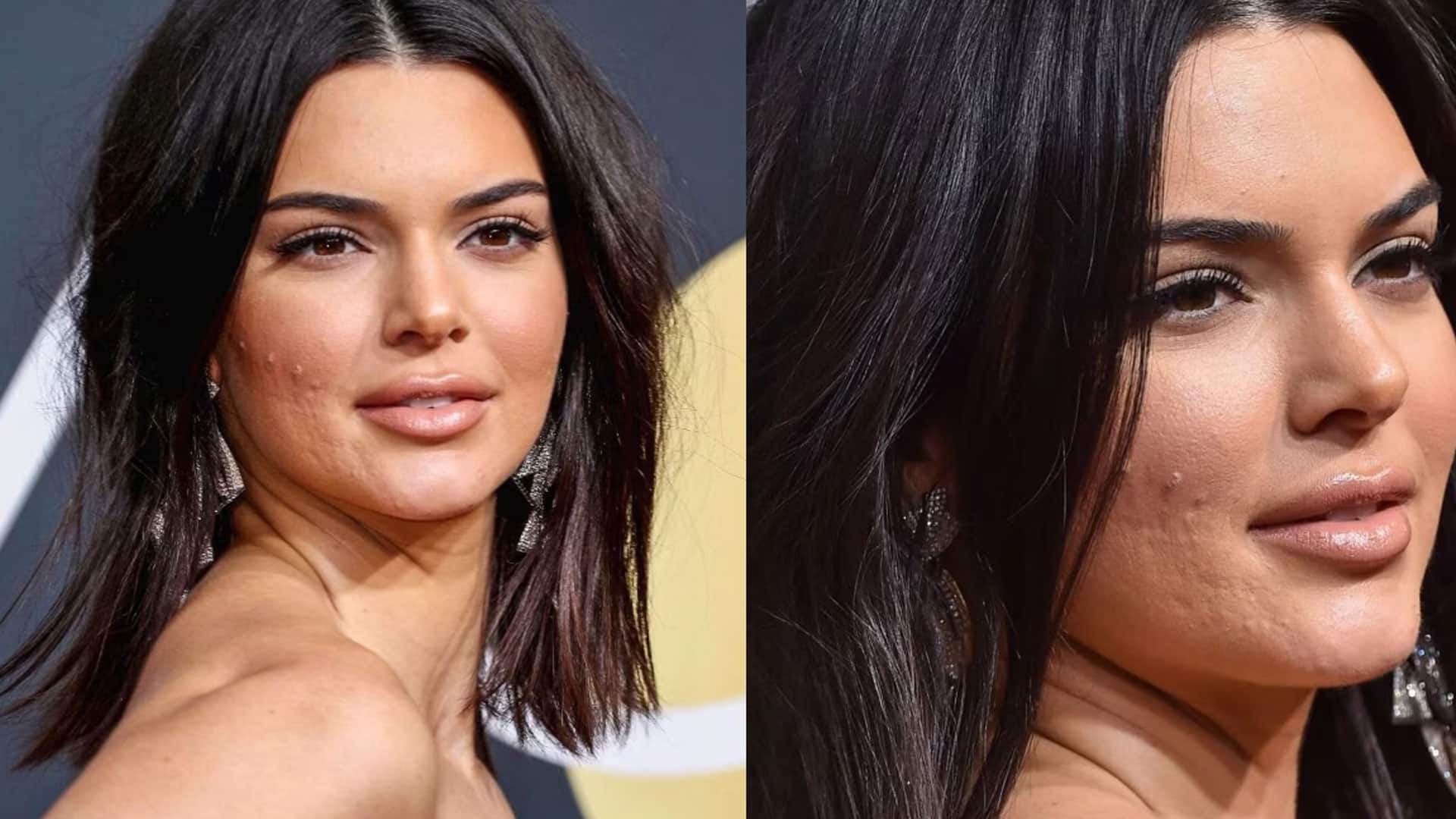 Kendall Jenners Cosmetic Journey Surgerytr 