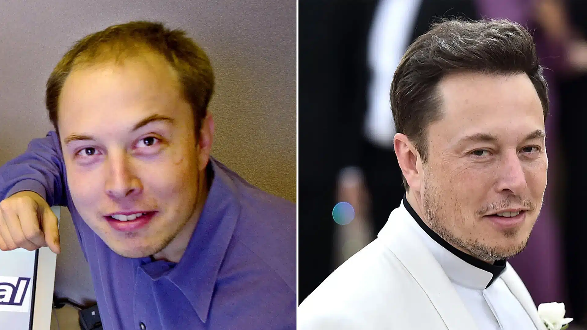 Elon Musk Saç Ektirdi mi? 1 ELON2