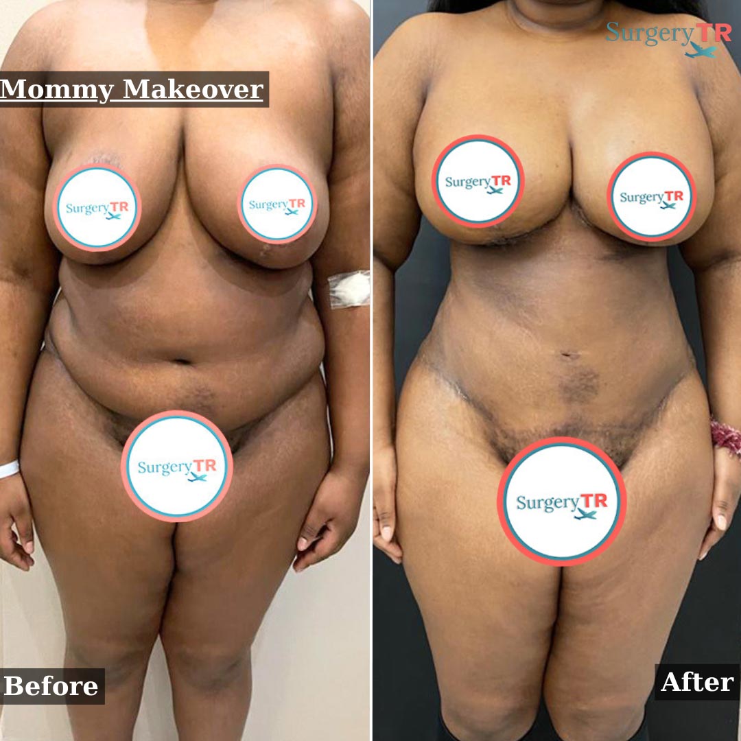 Mommy Makeover 1