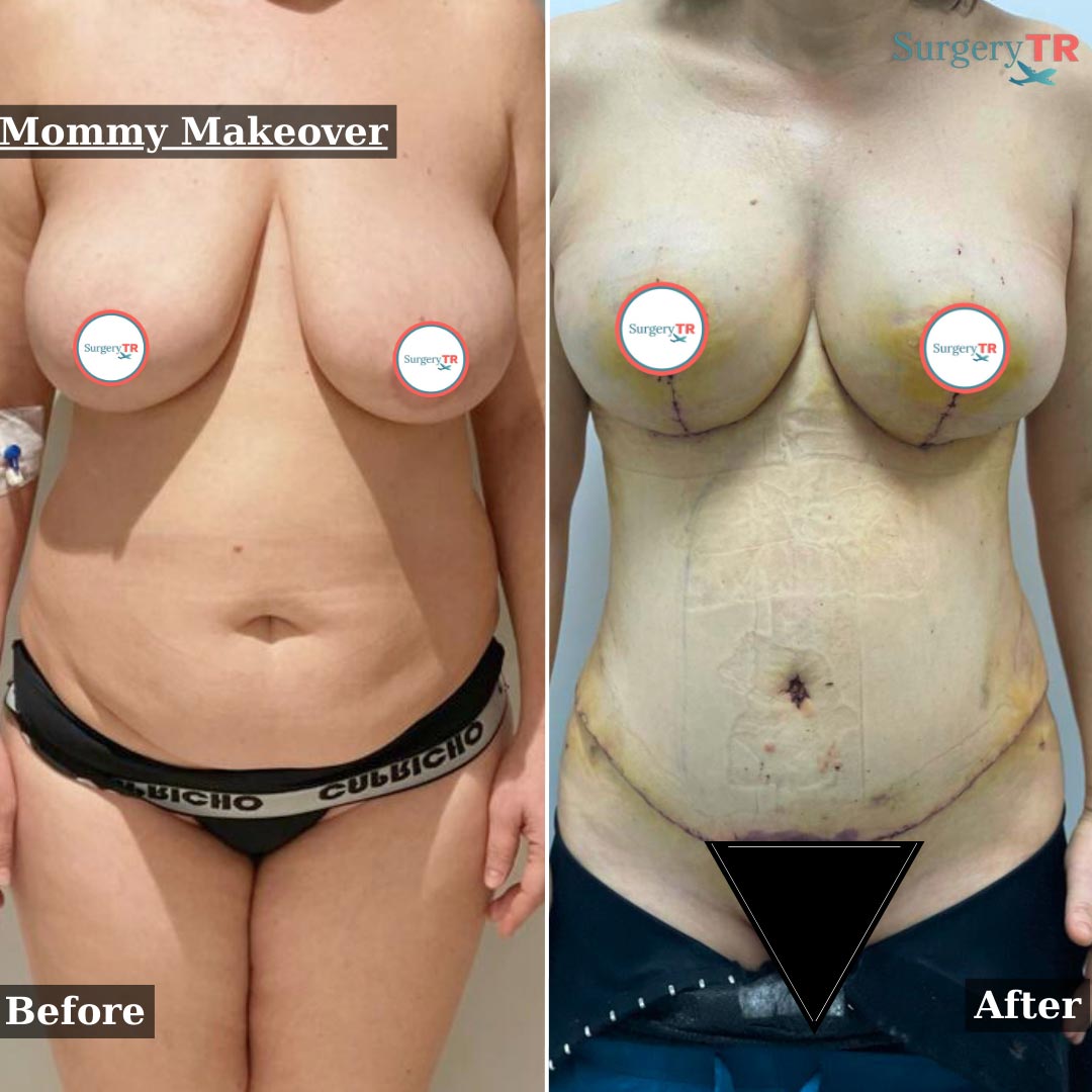 Mommy Makeover 2