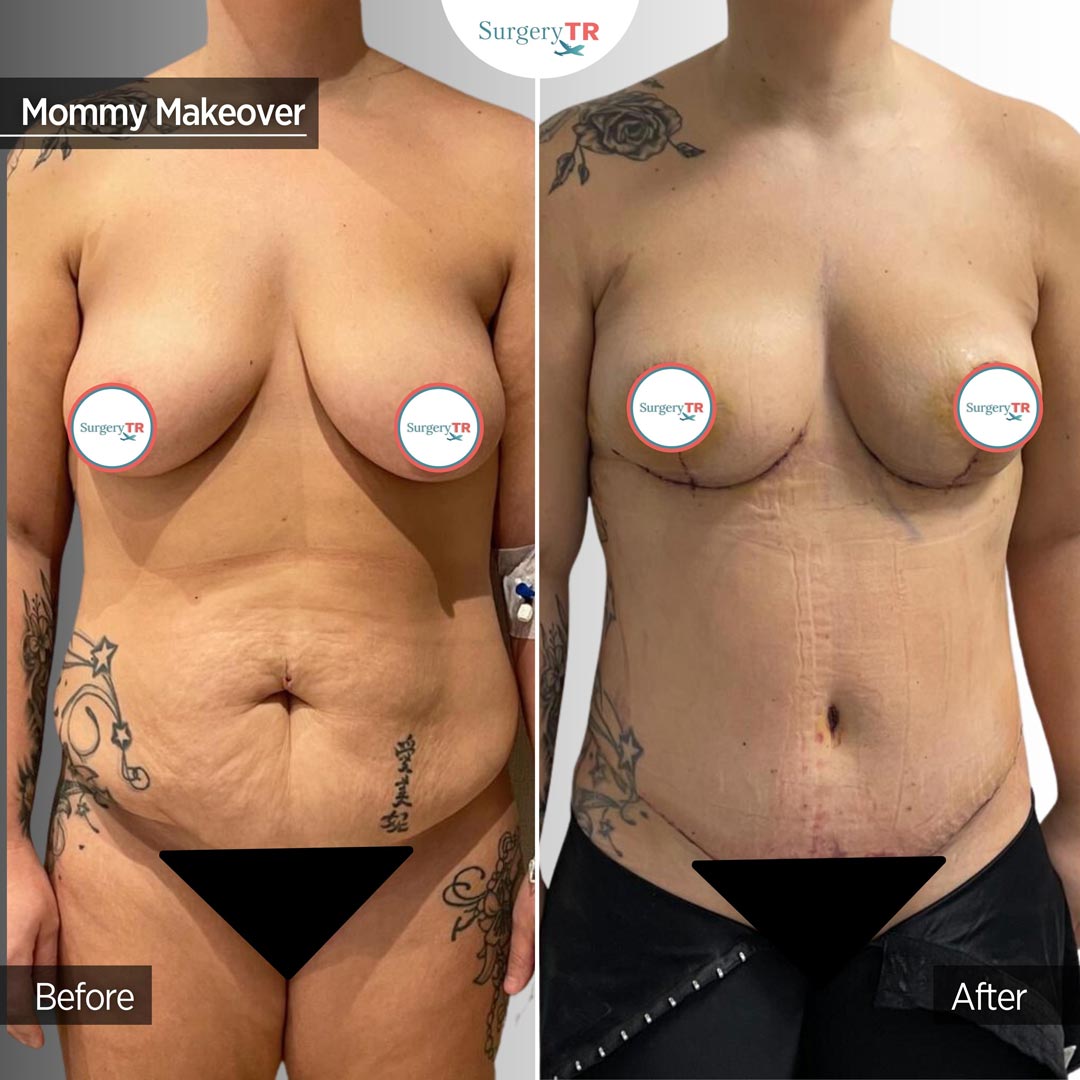 Mommy Makeover 3