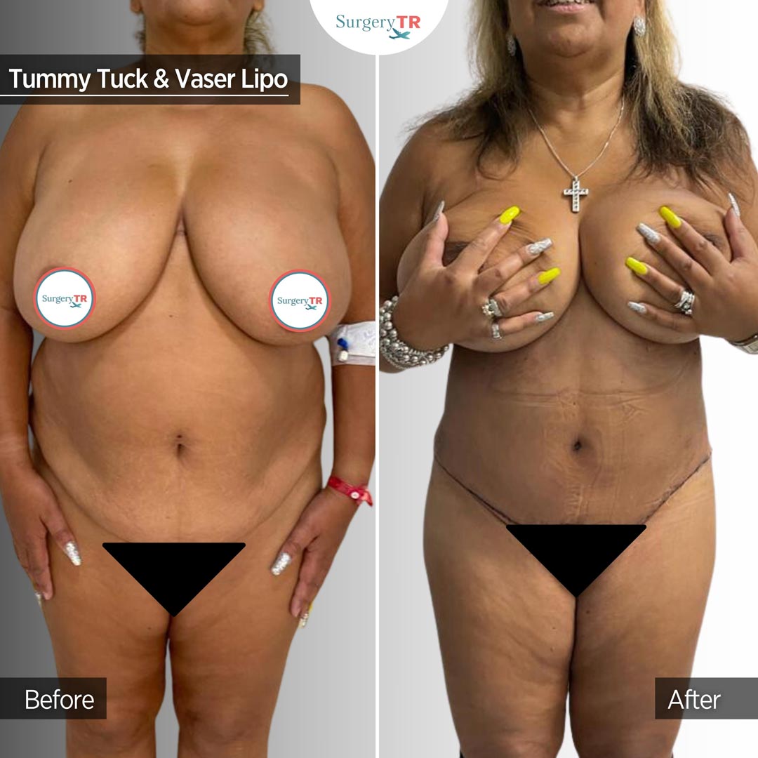Tummy Tuck 1