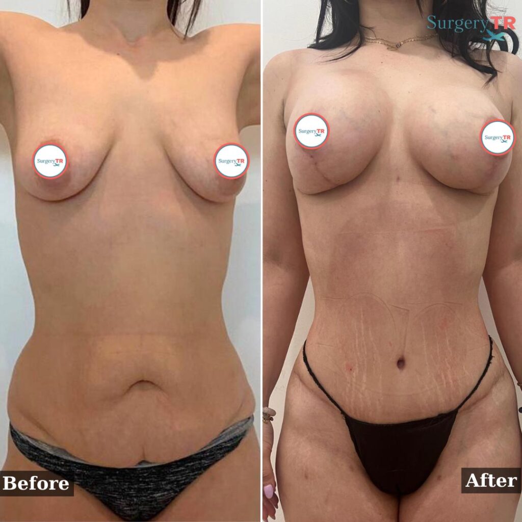 Tummy Tuck 2