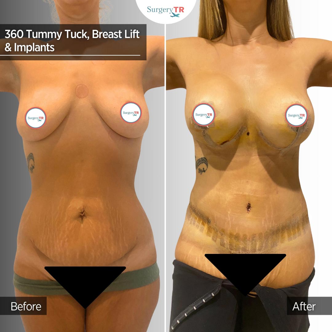Tummy Tuck 3
