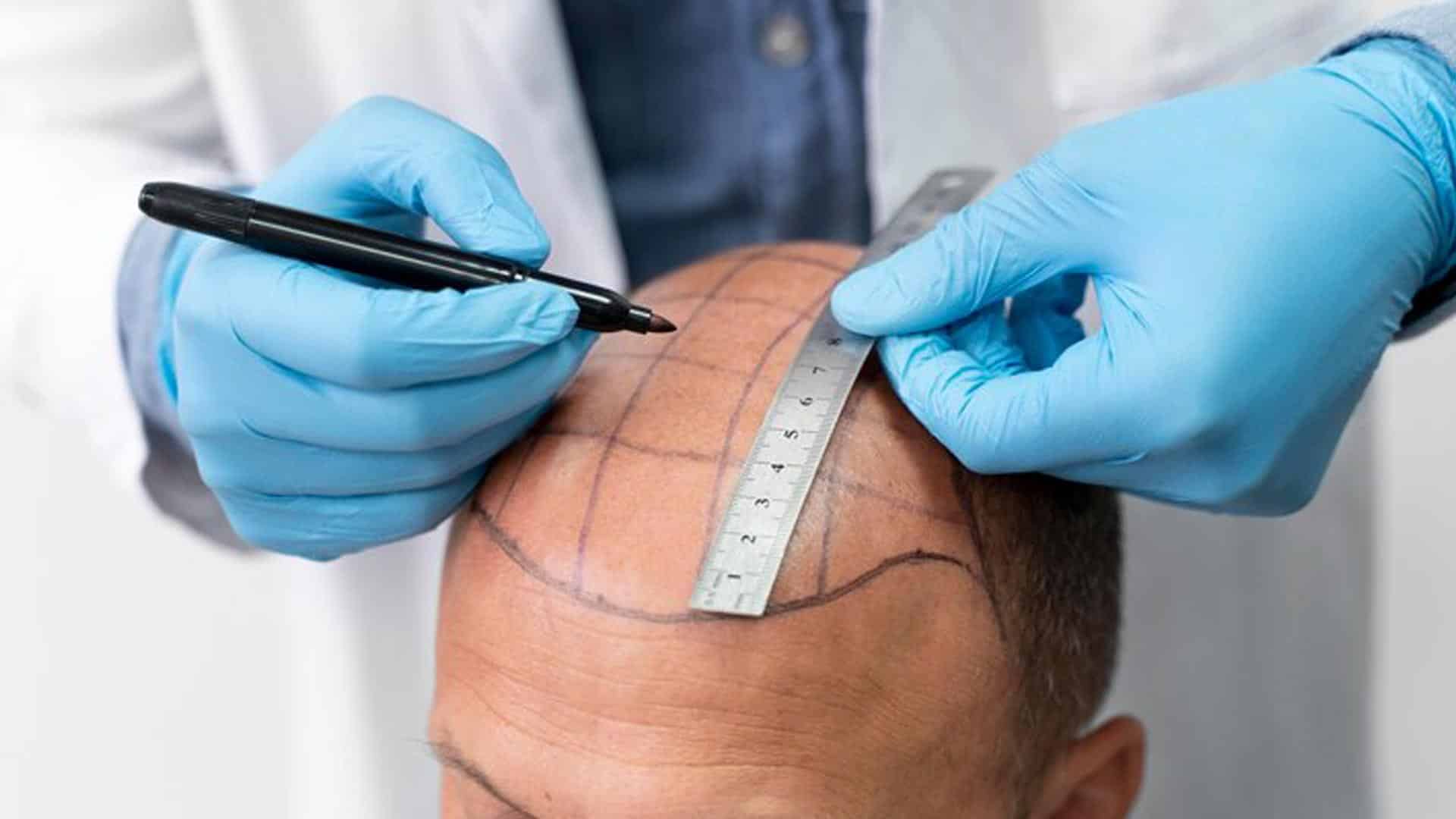 Why Do People Get Hair Transplants in Turkey?