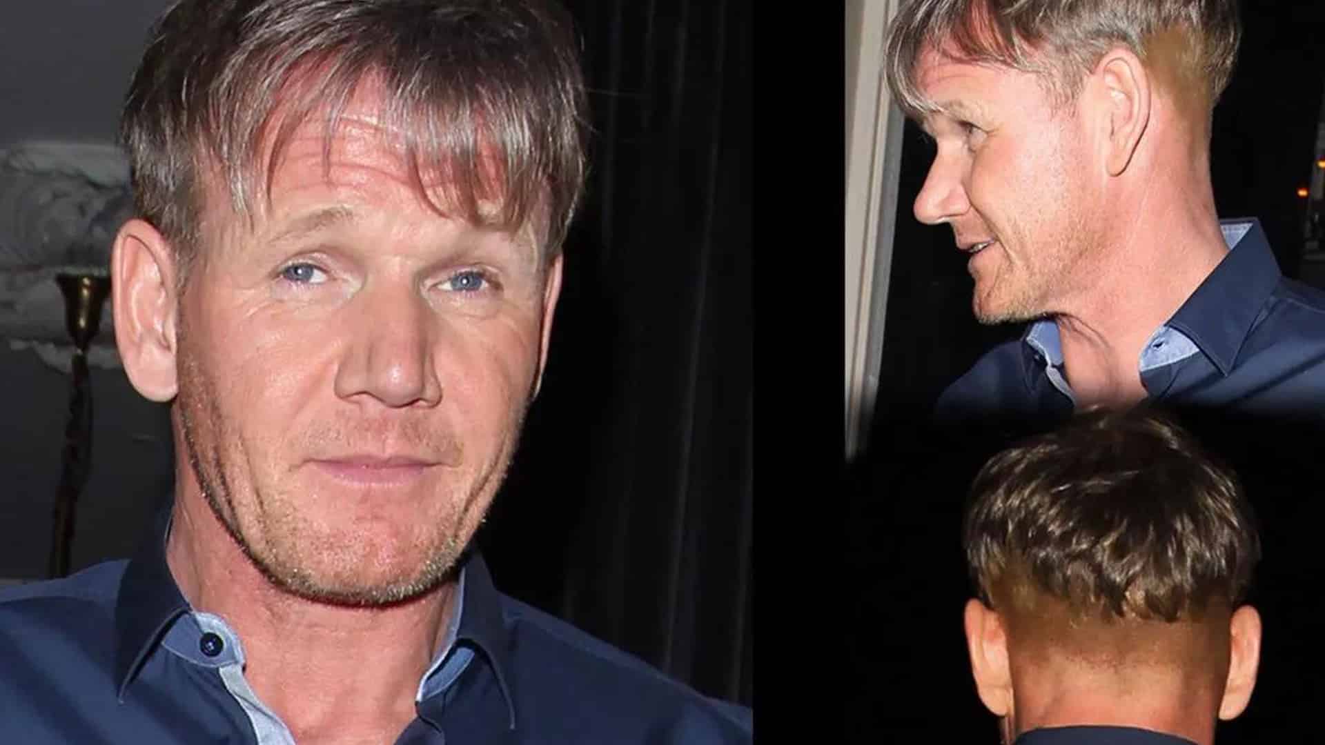 Gordon Ramsay’s Hair Transplant