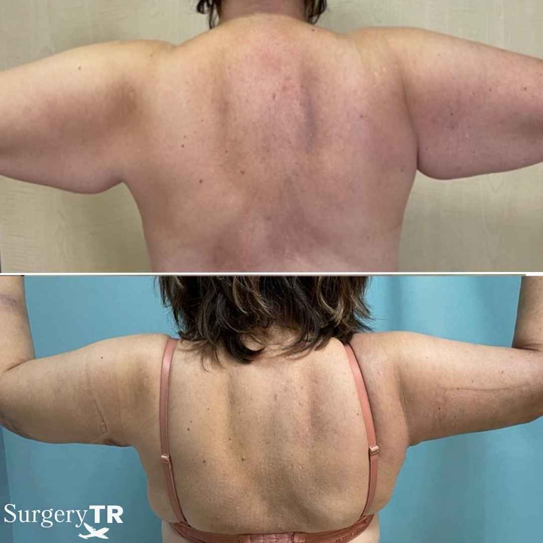 ArmLift BeforeAfter 1
