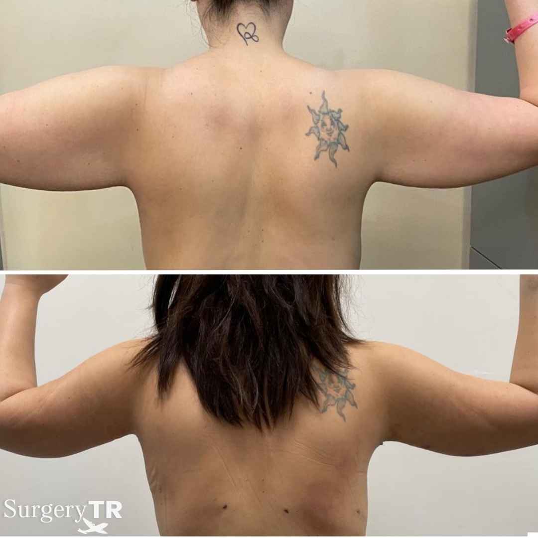 ArmLift BeforeAfter 2