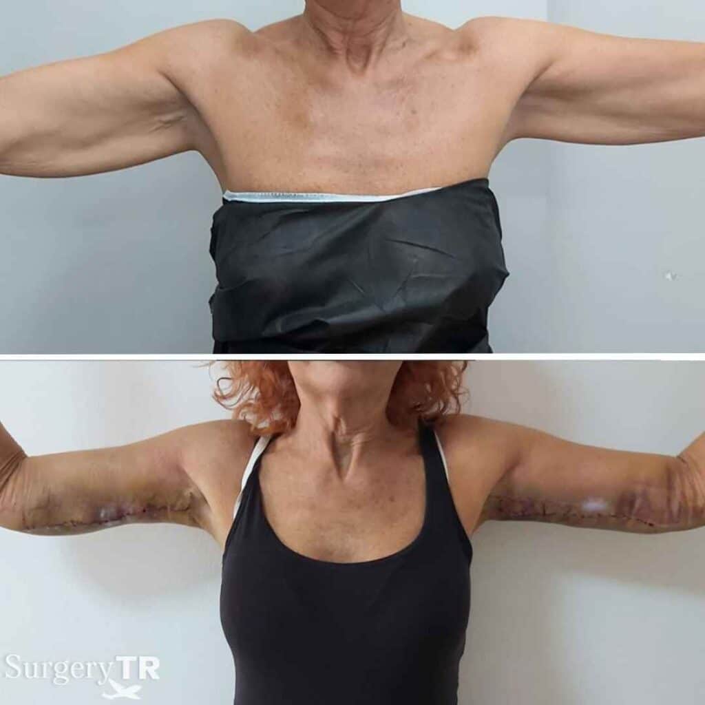 ArmLift BeforeAfter 3