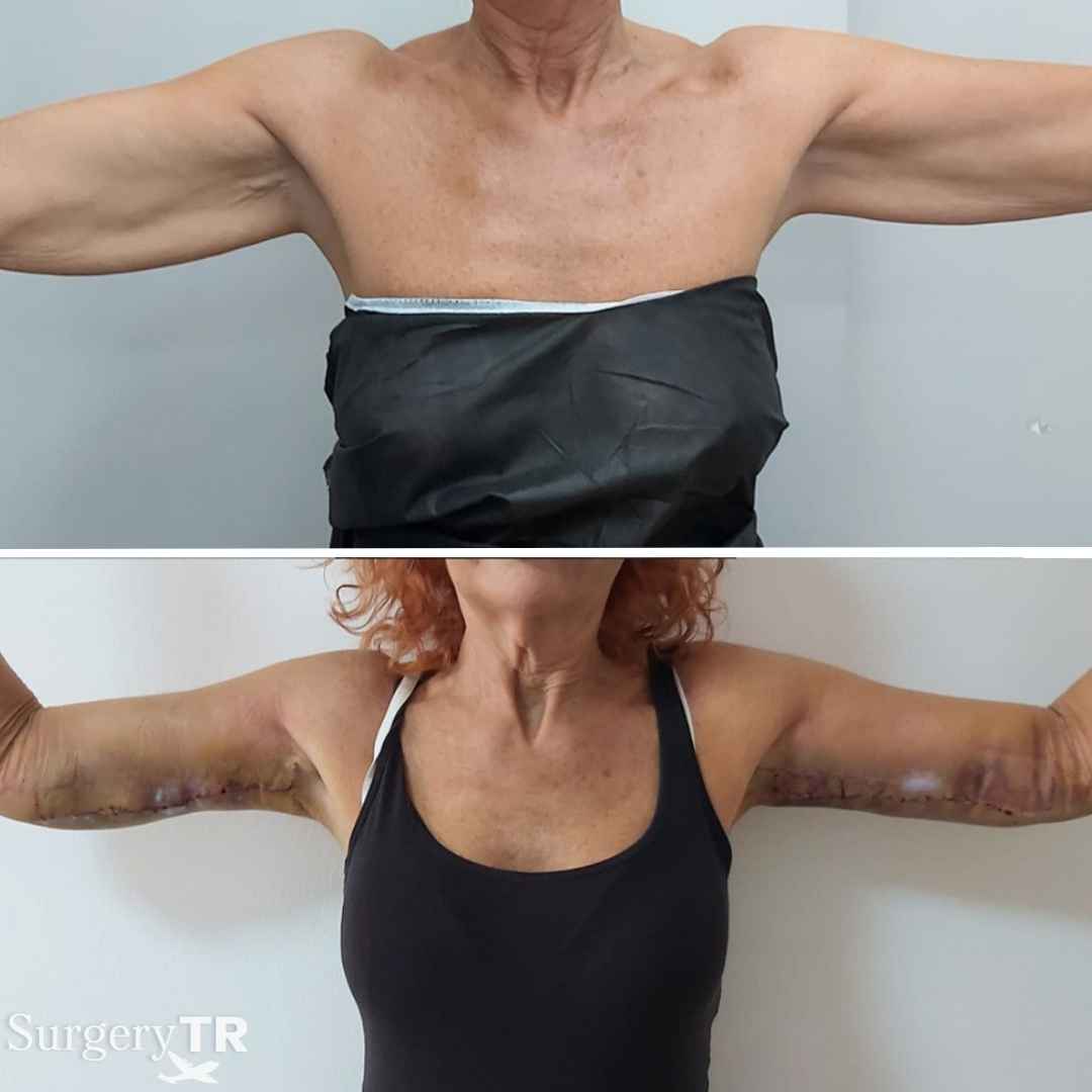 ArmLift BeforeAfter 3