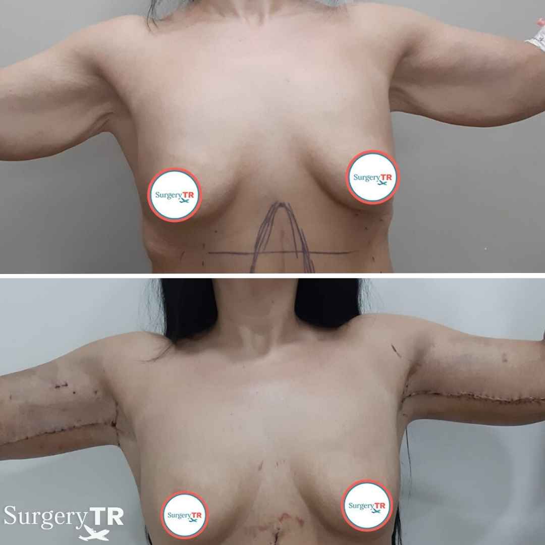 ArmLift BeforeAfter 4