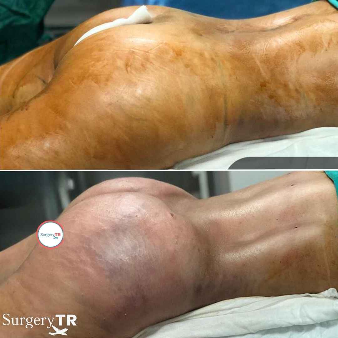 BBL BeforeAfter 1
