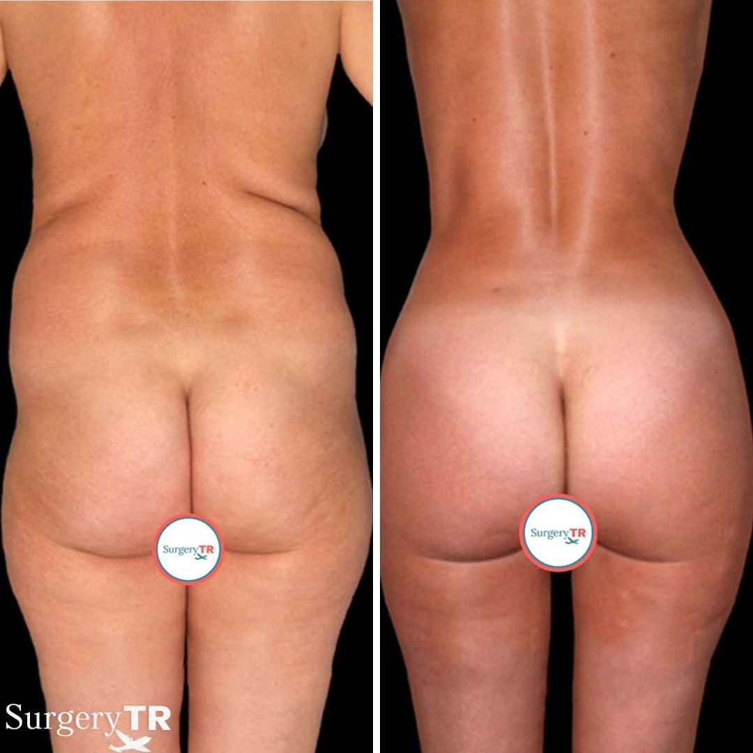 BBL BeforeAfter 4
