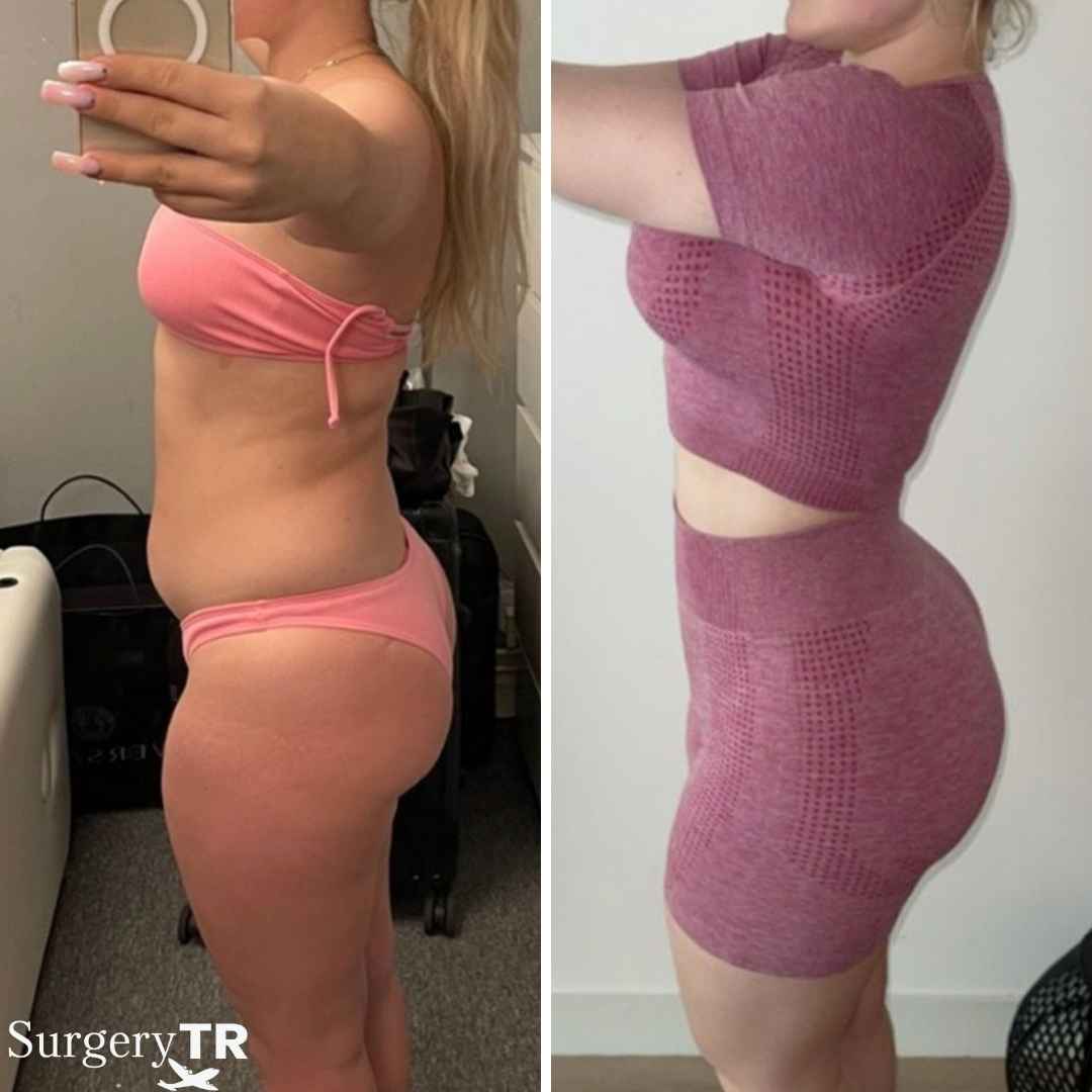 BBL BeforeAfter 5