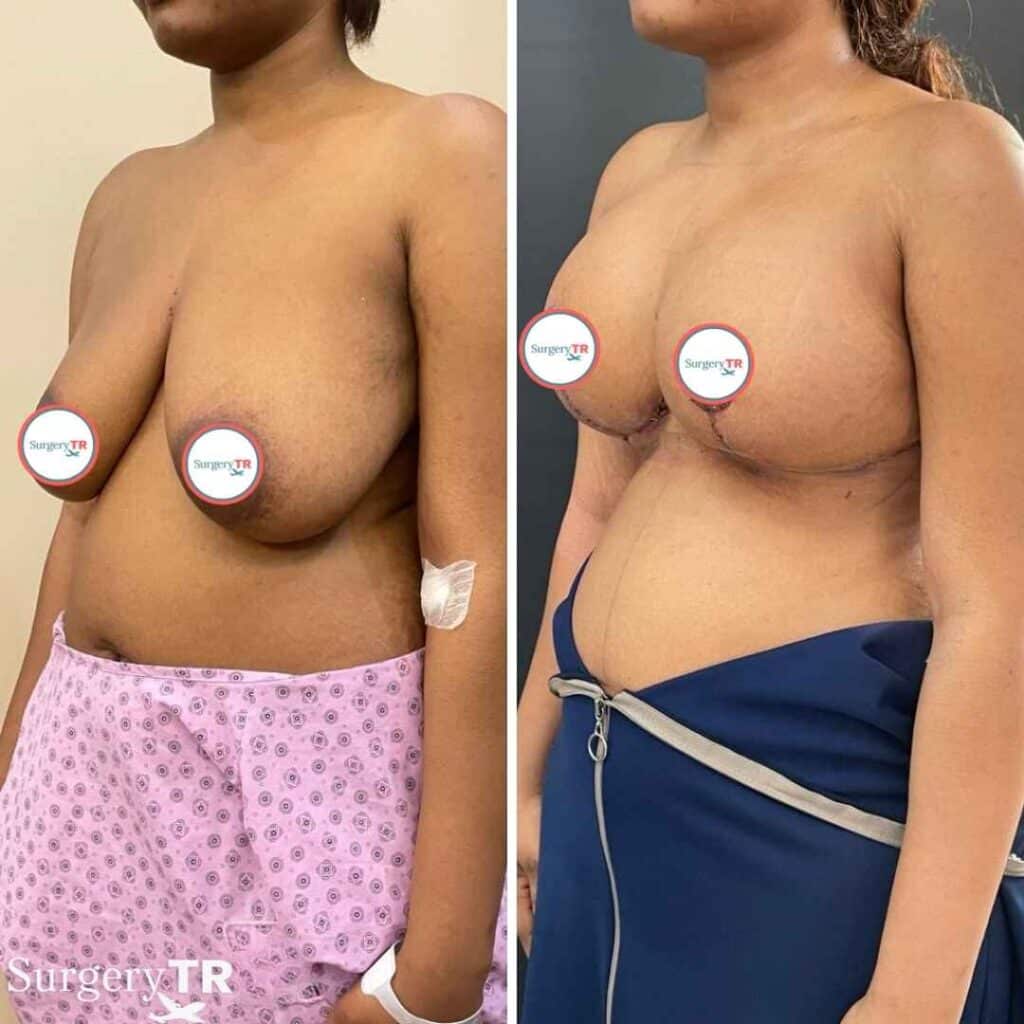 Breast Lift Before After 1