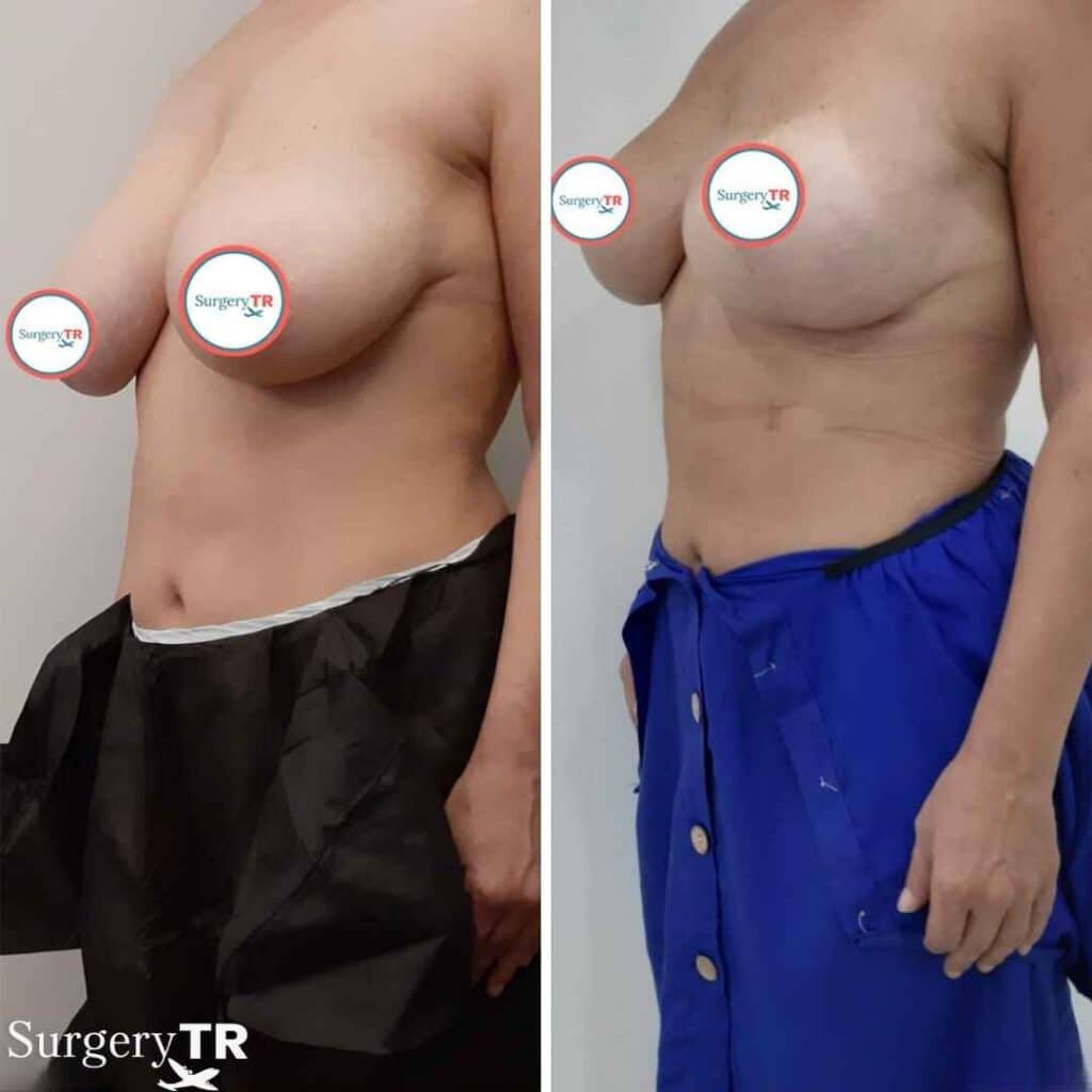 Breast Lift Before After 2