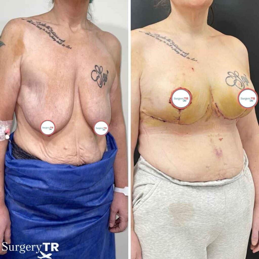 Breast Lift Before After 3