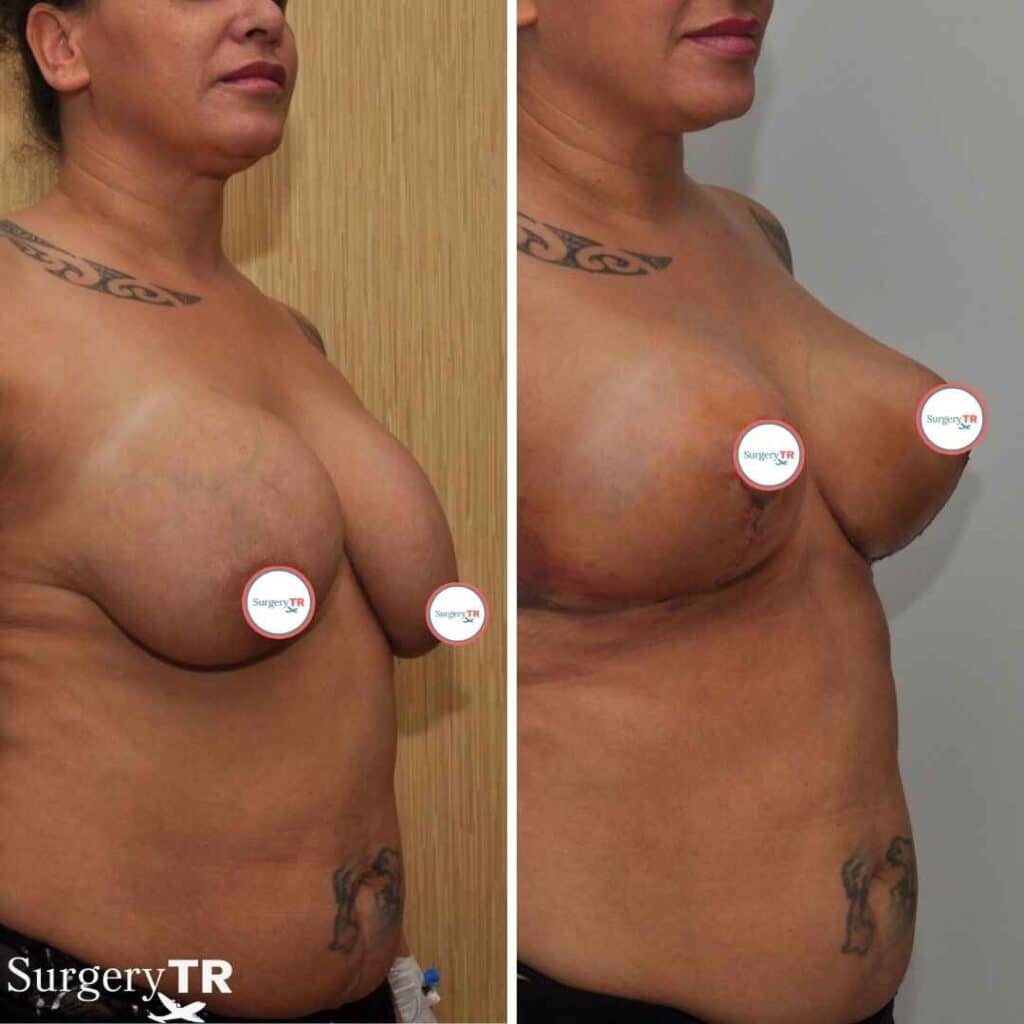 Breast Lift Before After 5