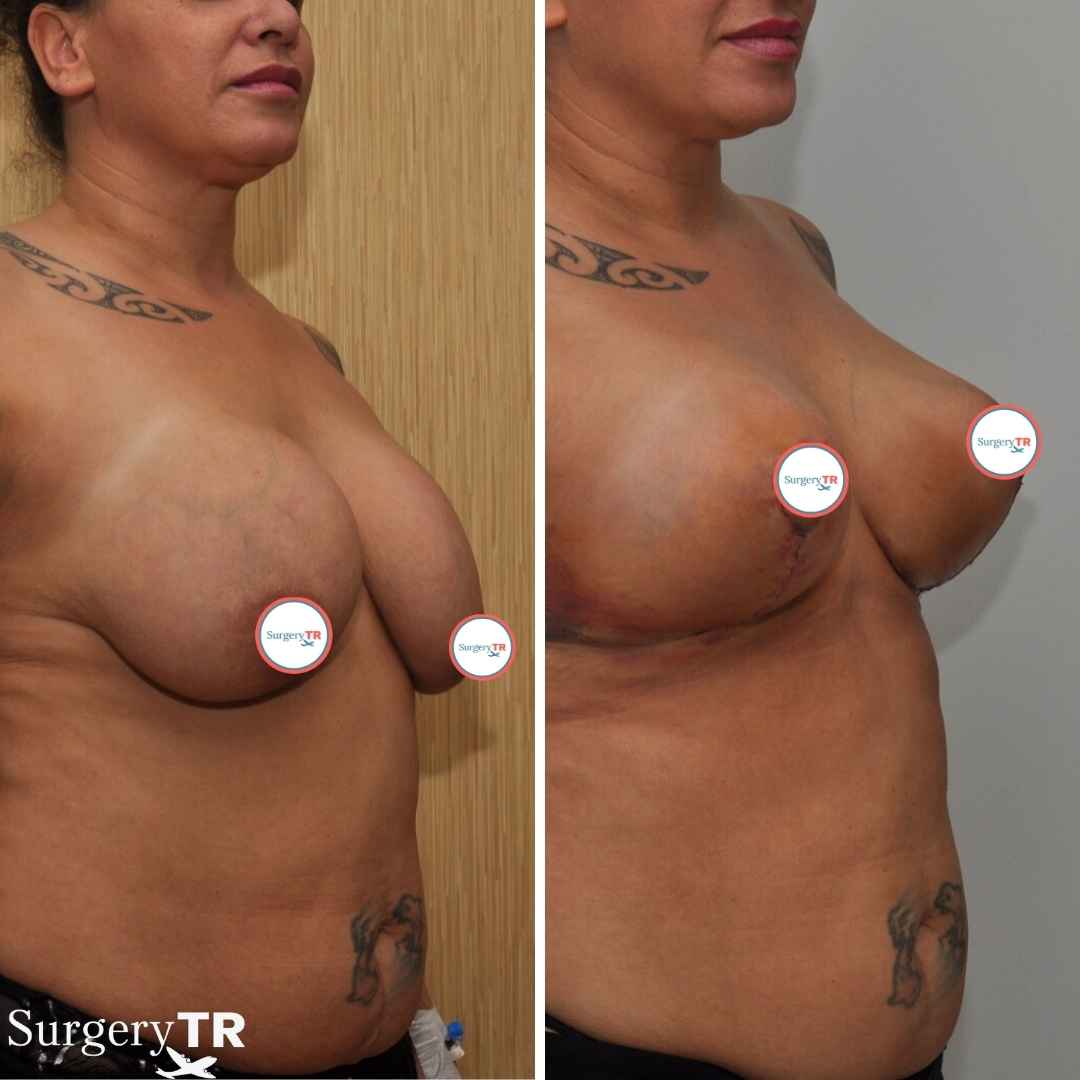 Breast Lift Before After 5