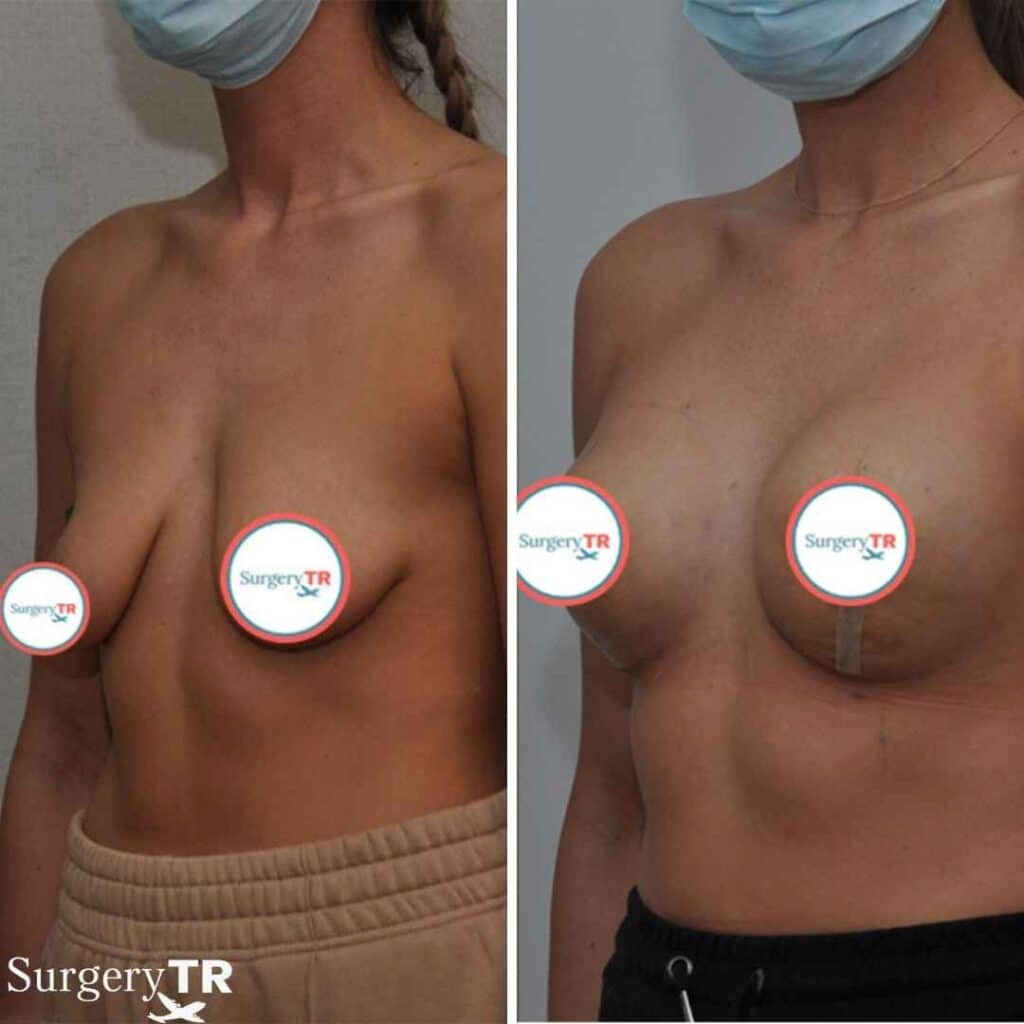 Jessie J’s Battle with Breast Cancer: When Aesthetic Surgery Becomes Life-Saving, Not Just Beautifying 3 Breast Lift Before After 6