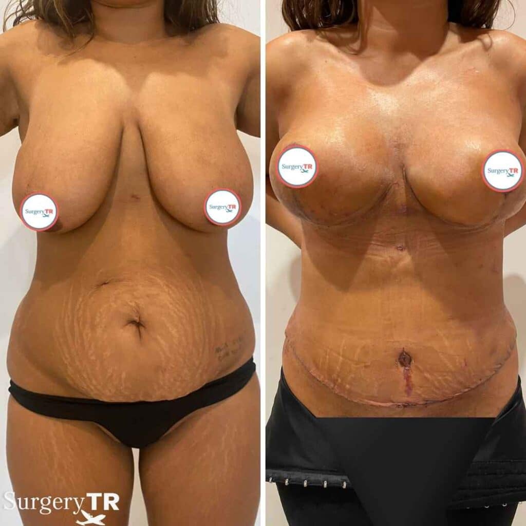 Breast Lift Before After 7