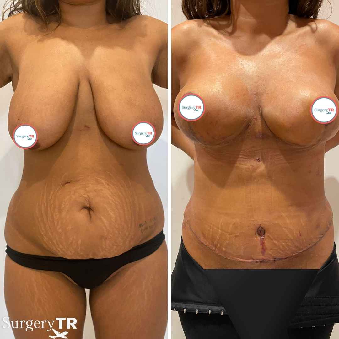 Breast Lift Before After 7