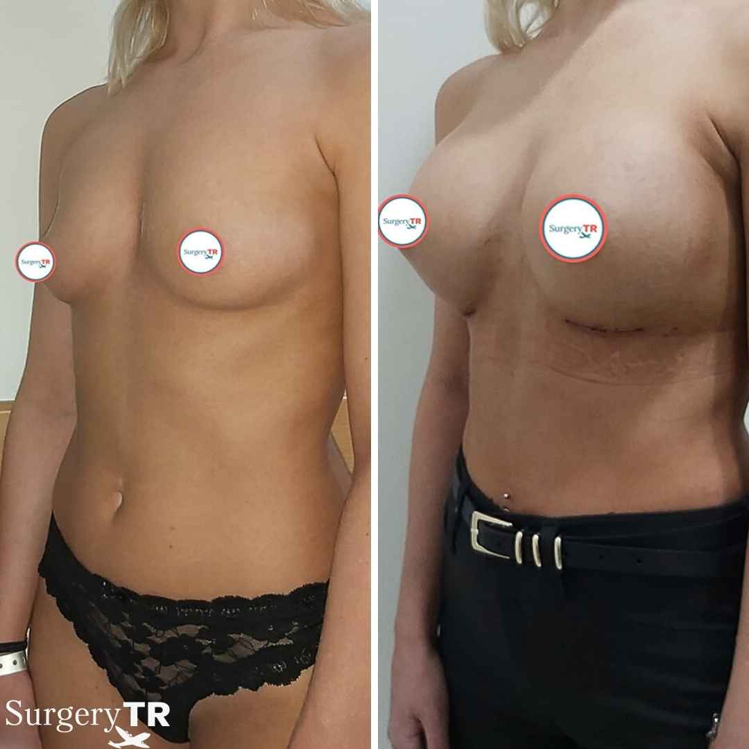 BreastImplants BeforeAfte 1