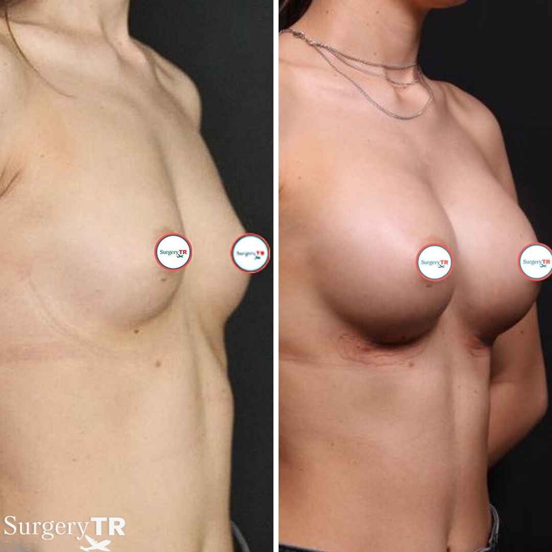 BreastImplants BeforeAfte 2