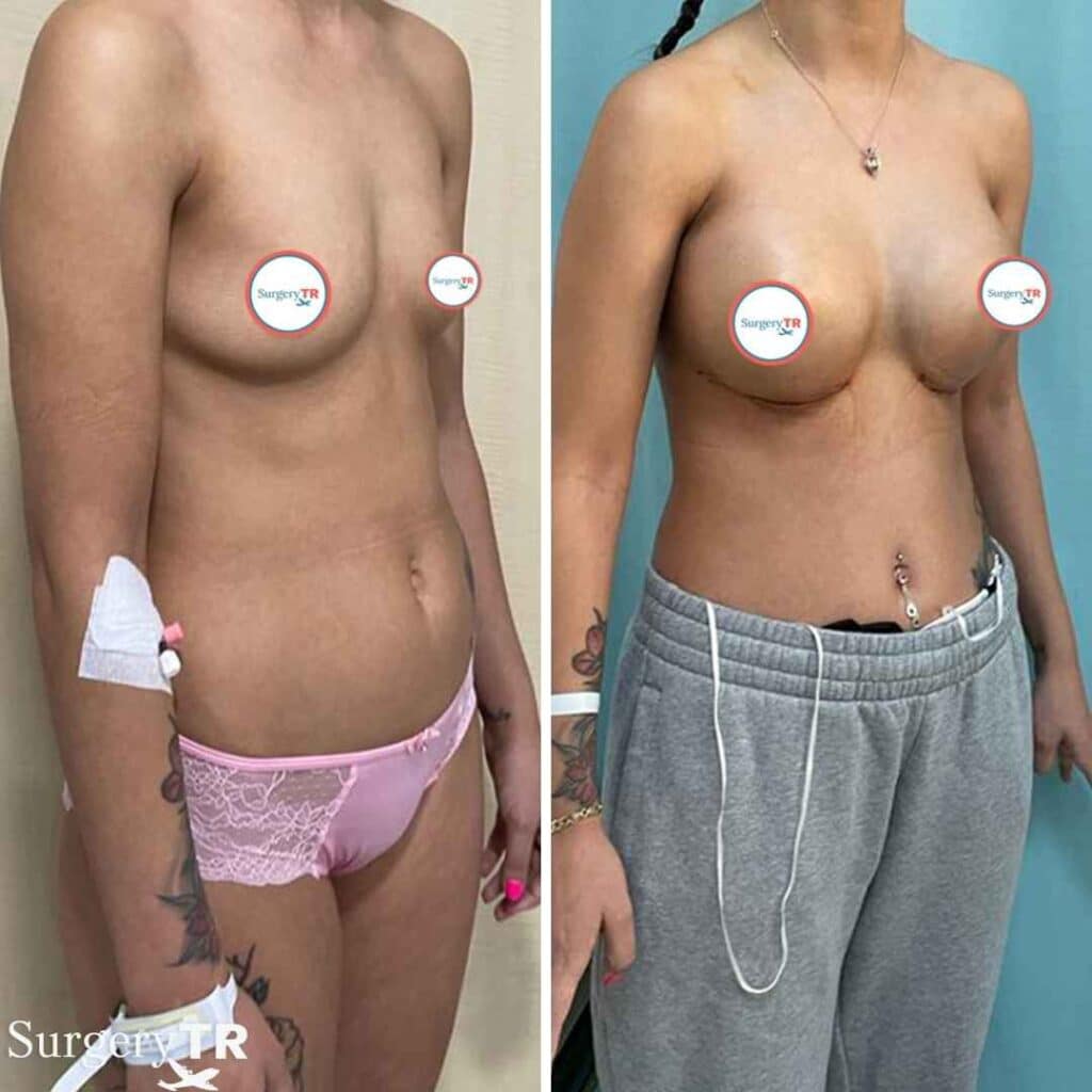 The Most Natural Looking Breast Implants: What Are Your Options? 2 BreastImplants BeforeAfte 3