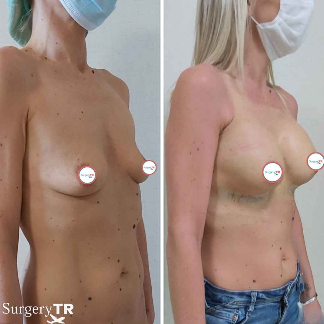 BreastImplants BeforeAfte 4