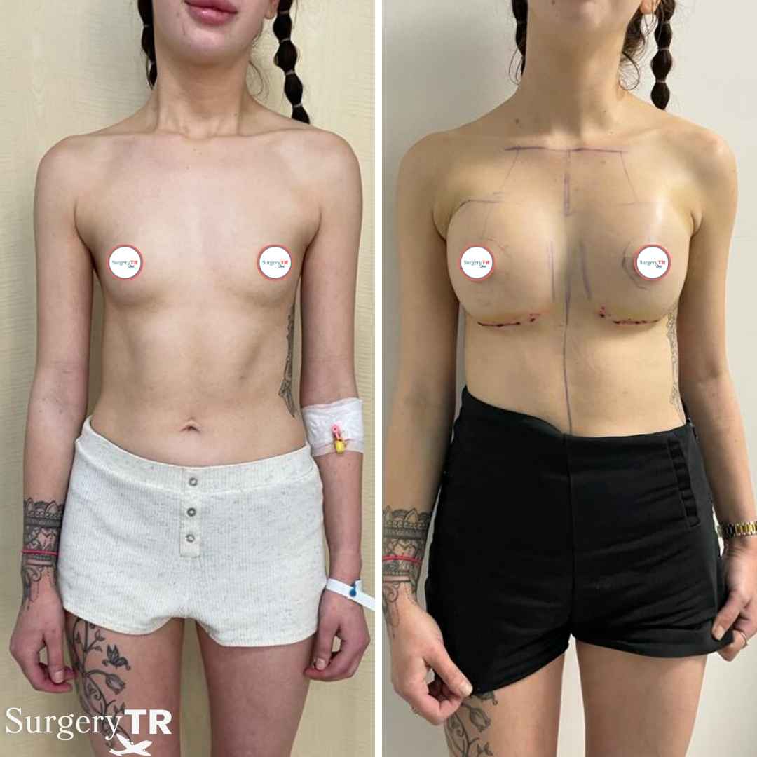 BreastImplants BeforeAfte 5