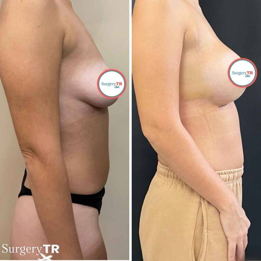 BreastImplants BeforeAfte 6