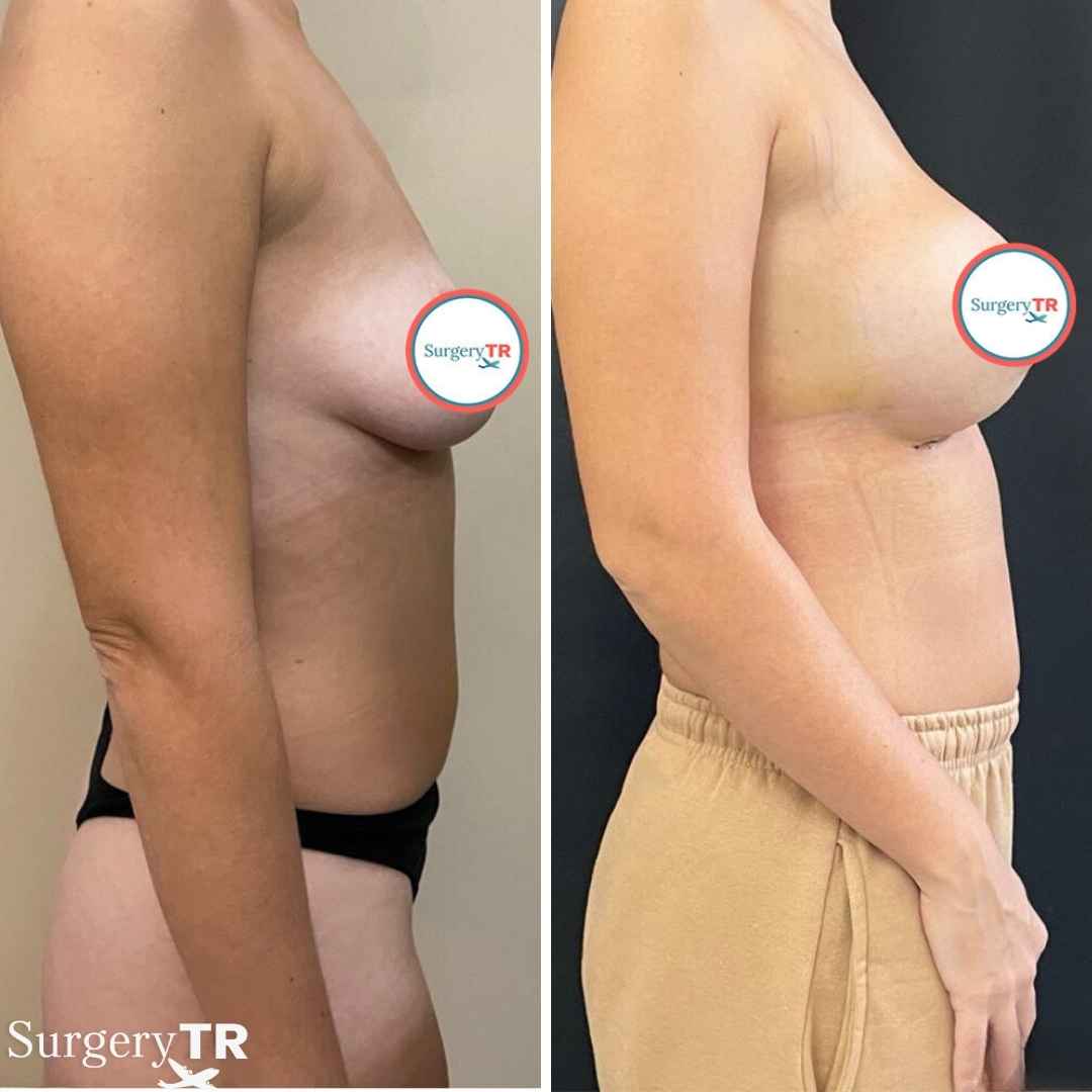 BreastImplants BeforeAfte 6
