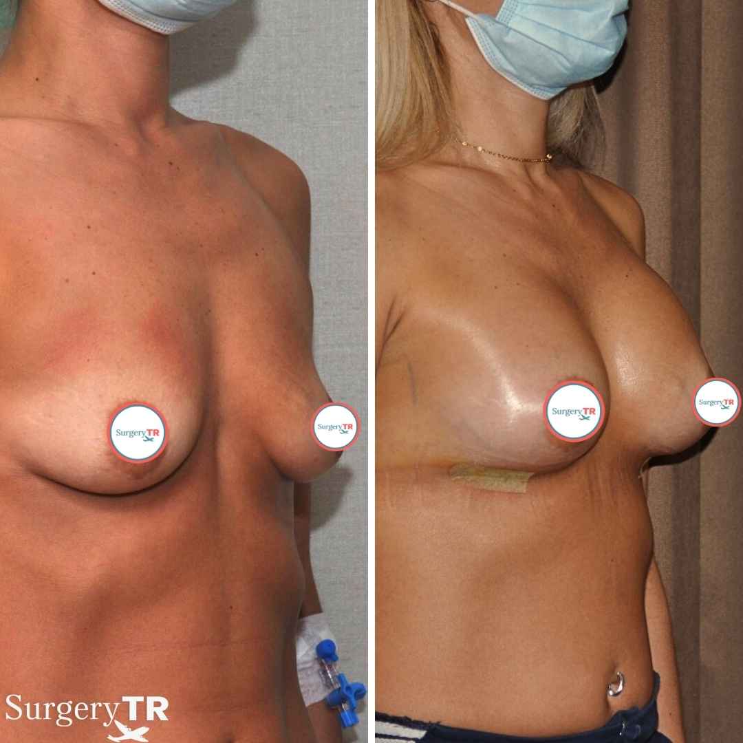 BreastImplants BeforeAfte 7
