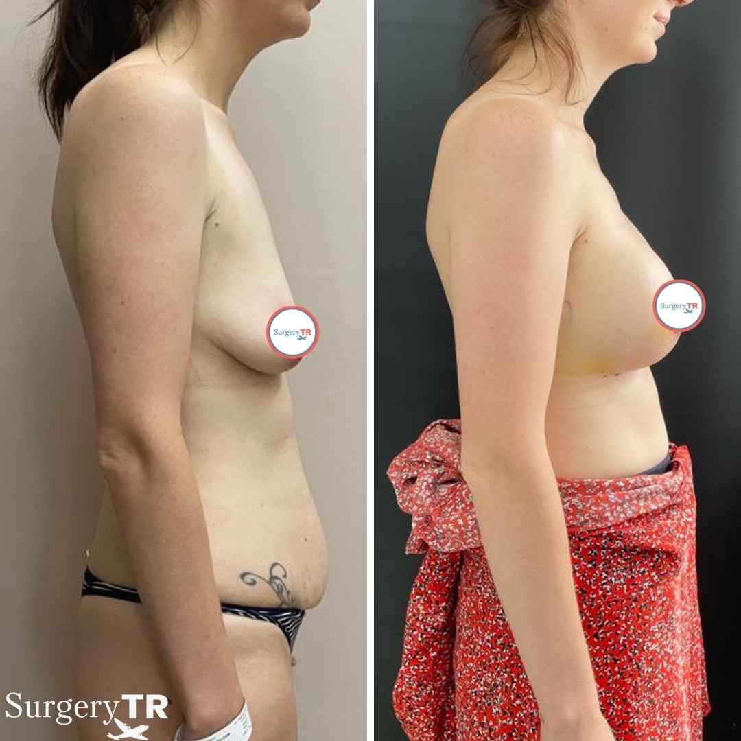 BreastImplants BeforeAfte 8