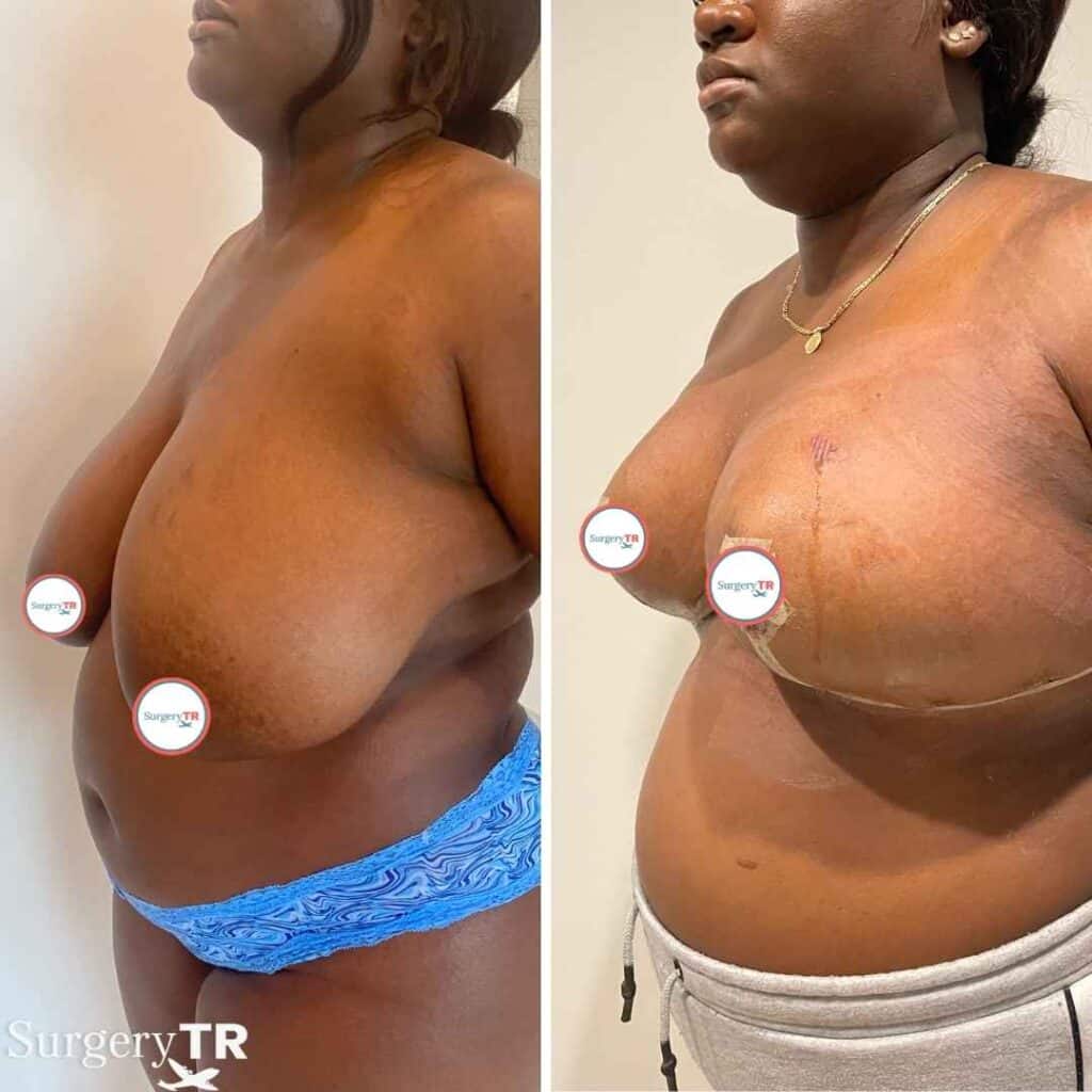 BreastReduction Before After 1