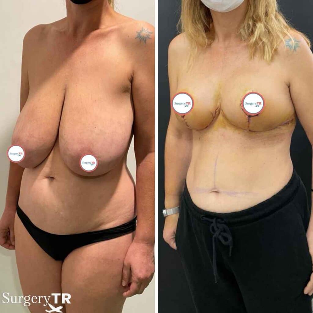 BreastReduction Before After 2