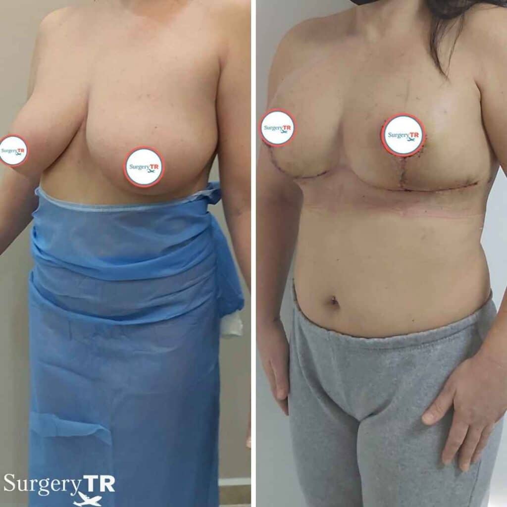 BreastReduction Before After 3