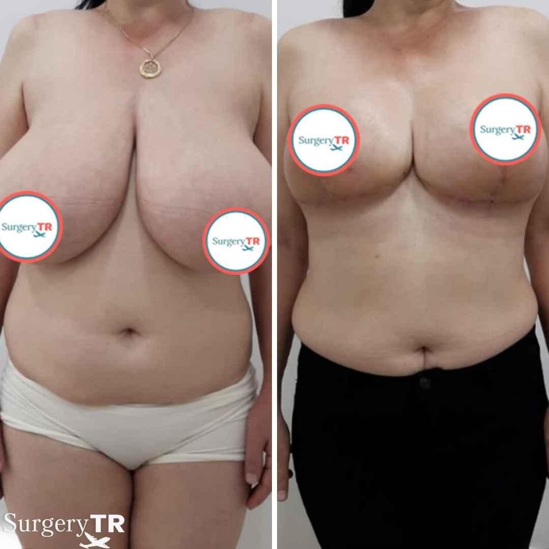 BreastReduction Before After 4