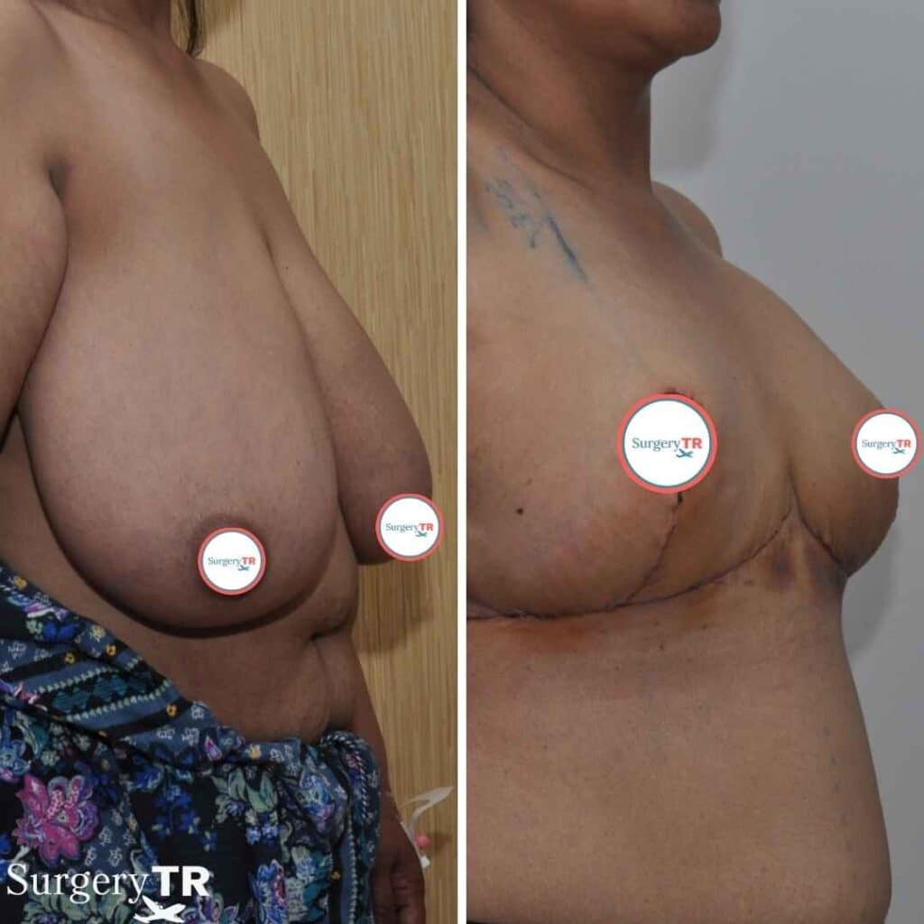 BreastReduction Before After 5