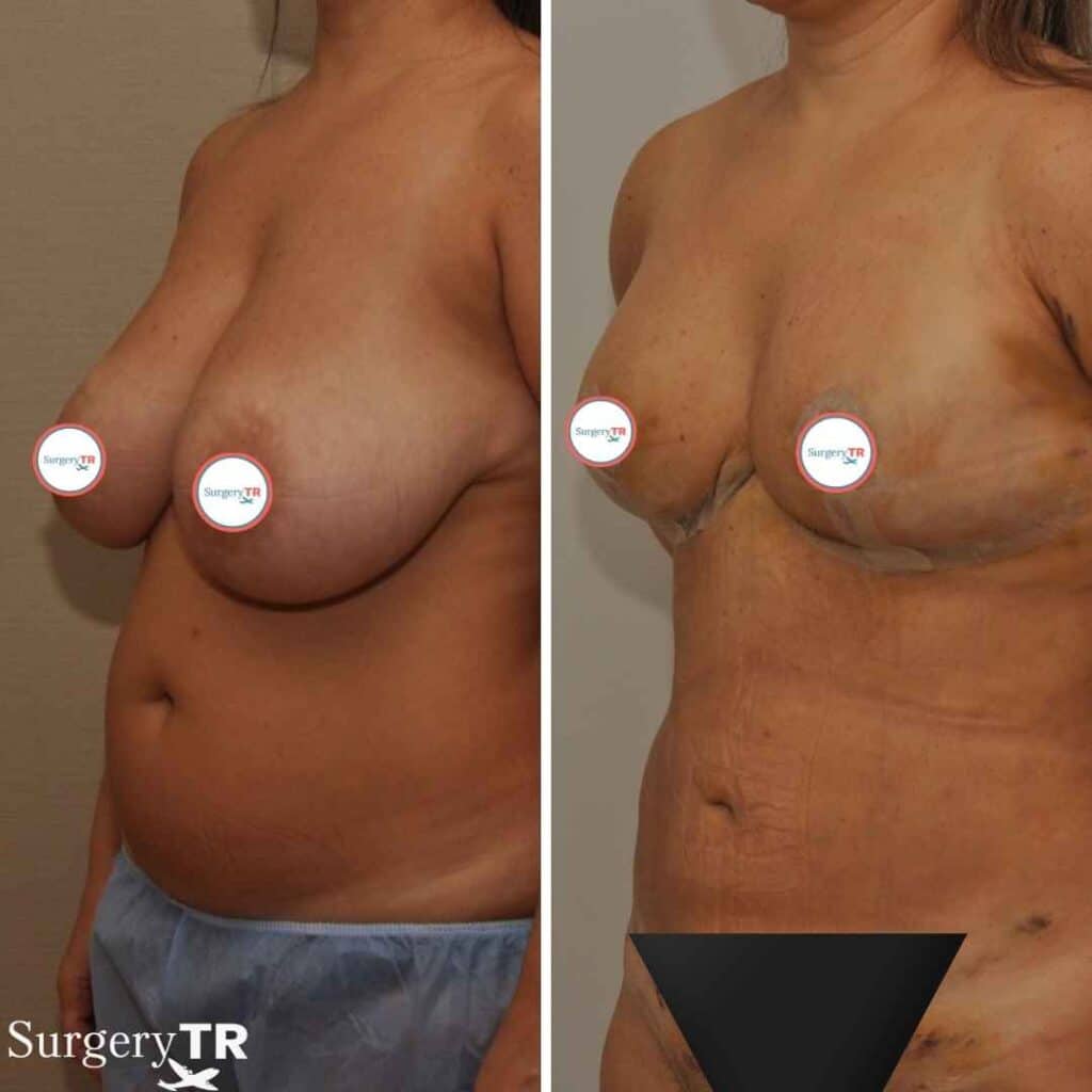 BreastReduction Before After 6