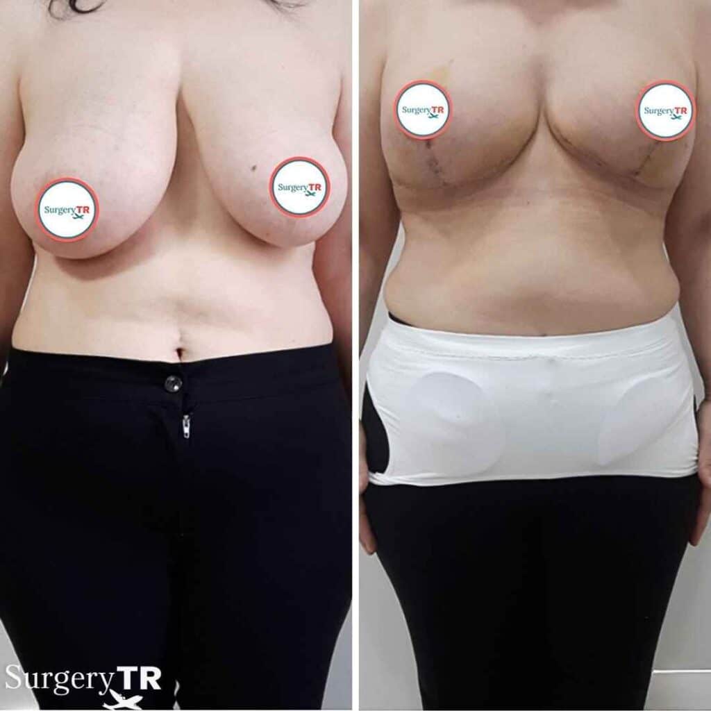 BreastReduction Before After 7