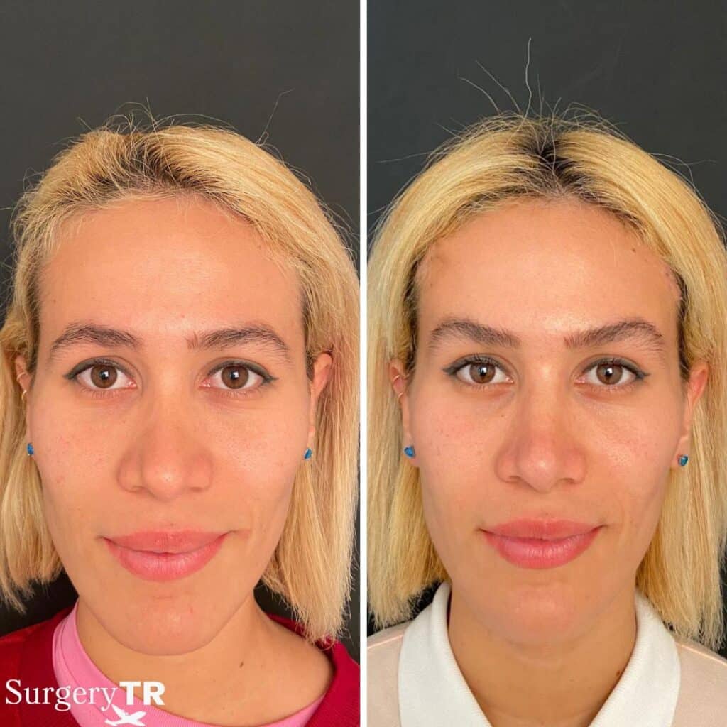 BrownLift Before After1