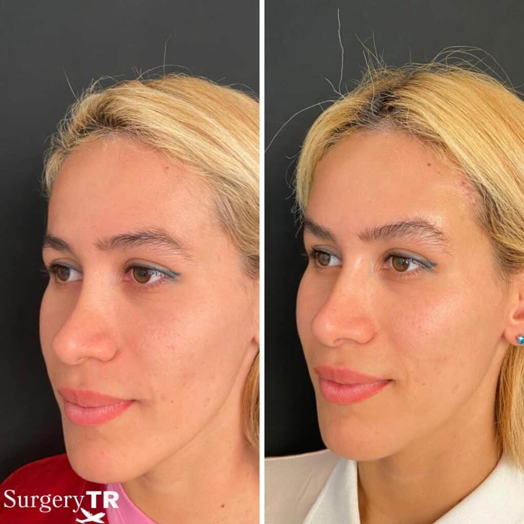 BrownLift Before After2